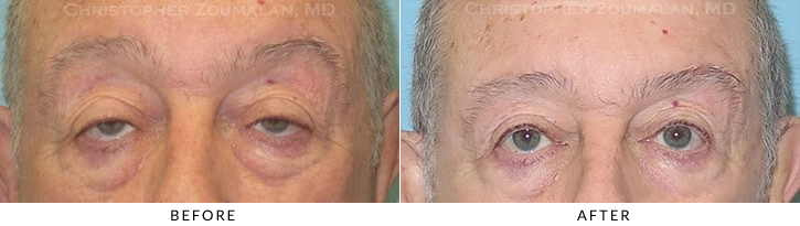 Ptosis Surgery Before & After Photo -  - Patient 12