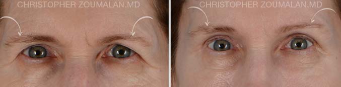 Upper brow lift - female patient before and after picture