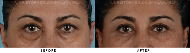 Quad Blepharoplasty Before & After Photo - Patient Seeing Straight - Patient 20A