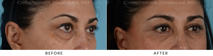 Quad Blepharoplasty Before & After Photo - Patient Seeing Side - Patient 20C