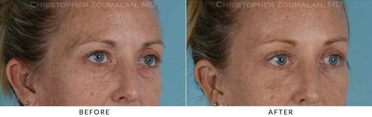 Quad Blepharoplasty Before & After Photo - Patient Seeing Side - Patient 21D