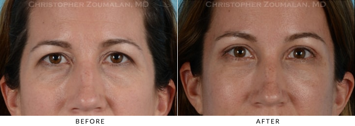 Quad Blepharoplasty Before & After Photo - Patient Seeing Side - Patient 22A