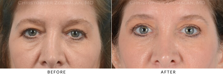 Quad Blepharoplasty Before & After Photo - Patient Seeing Straight - Patient 23A