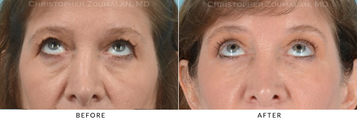 Quad Blepharoplasty Before & After Photo - Patient Seeing Up - Patient 23B