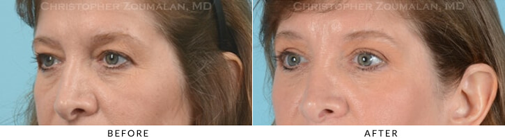 Quad Blepharoplasty Before & After Photo - Patient Seeing Side - Patient 23C