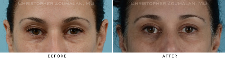 Quad Blepharoplasty Before & After Photo - Patient Seeing Straight - Patient 25A