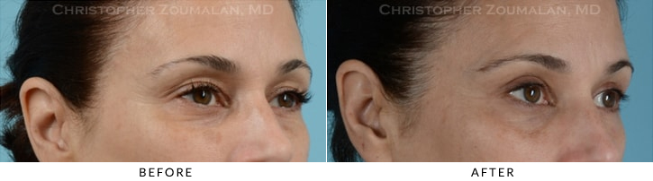 Quad Blepharoplasty Before & After Photo - Patient Seeing Side - Patient 25B