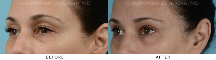 Quad Blepharoplasty Before & After Photo - Patient Seeing Side - Patient 25C