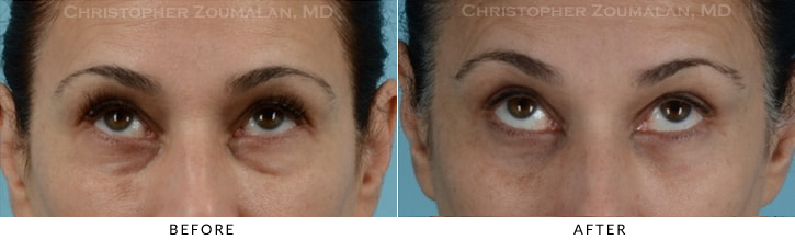 Quad Blepharoplasty Before & After Photo - Patient Seeing Up - Patient 25D