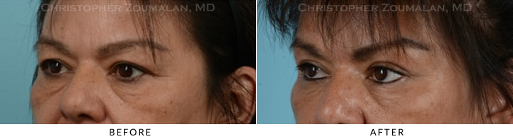 Quad Blepharoplasty Before & After Photo - Patient Seeing Side - Patient 27D
