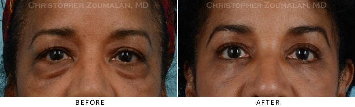 Quad Blepharoplasty Before & After Photo - Patient Seeing Straight - Patient 28A