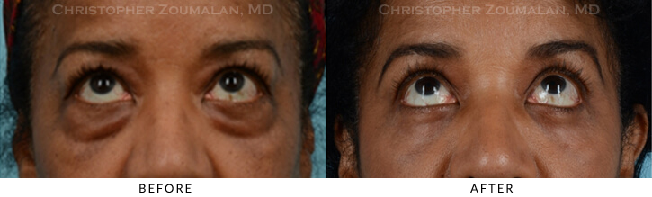 Quad Blepharoplasty Before & After Photo - Patient Seeing Up - Patient 28B
