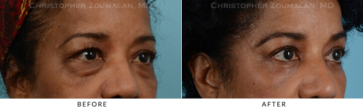 Quad Blepharoplasty Before & After Photo - Patient Seeing Side - Patient 28C