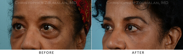 Quad Blepharoplasty Before & After Photo - Patient Seeing Side - Patient 28D