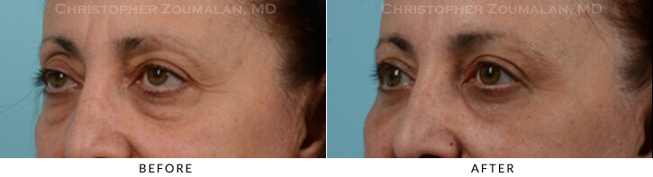 Quad Blepharoplasty Before & After Photo - Patient Seeing Side - Patient 29A