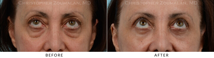 Quad Blepharoplasty Before & After Photo - Patient Seeing Up - Patient 29B
