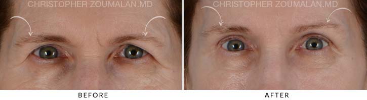 Quad Blepharoplasty Before & After Photo - Patient Seeing Straight - Patient 11A