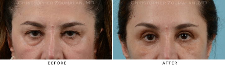 Quad Blepharoplasty Before & After Photo - Patient Seeing Straight - Patient 30C