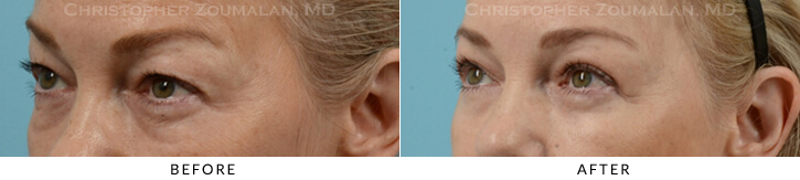 Quad Blepharoplasty Before & After Photo -  - Patient 31