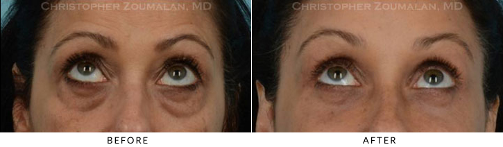 Quad Blepharoplasty Before & After Photo - Patient Seeing Up - Patient 32A