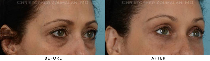 Quad Blepharoplasty Before & After Photo - Patient Seeing Side - Patient 32B