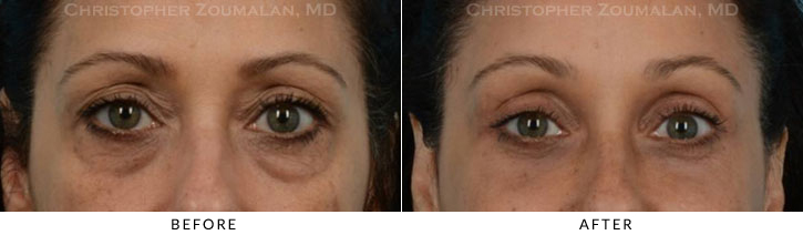 Quad Blepharoplasty Before & After Photo - Patient Seeing Straight - Patient 32D