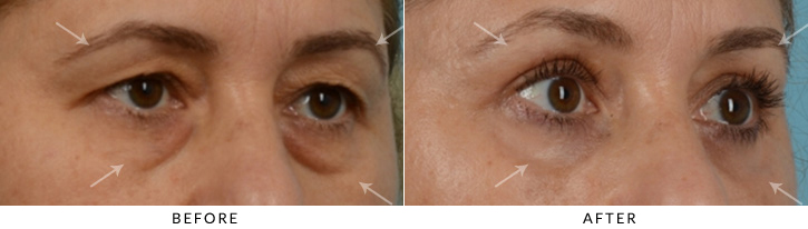 Quad Blepharoplasty Before & After Photo - Patient Seeing Side - Patient 33A