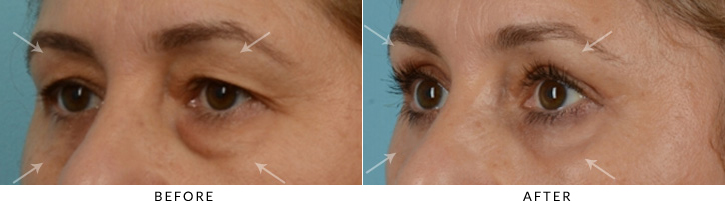 Quad Blepharoplasty Before & After Photo - Patient Seeing Side - Patient 33B