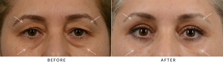 Quad Blepharoplasty Before & After Photo - Patient Seeing Straight - Patient 33C