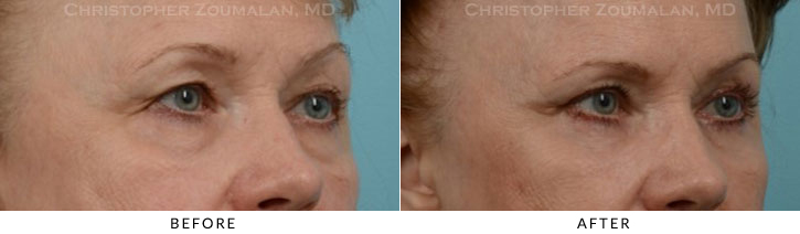 Quad Blepharoplasty Before & After Photo -  - Patient 34