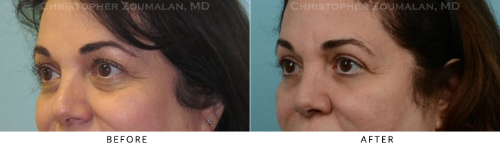 Quad Blepharoplasty Before & After Photo - Patient Seeing Side - Patient 35A