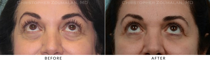 Quad Blepharoplasty Before & After Photo - Patient Seeing Up - Patient 35B
