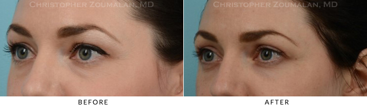Quad Blepharoplasty Before & After Photo - Patient Seeing Side - Patient 36A