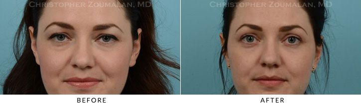 Quad Blepharoplasty Before & After Photo - Patient Seeing Straight - Patient 36B