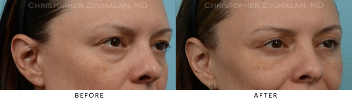 Quad Blepharoplasty Before & After Photo - Patient Seeing Side - Patient 37A