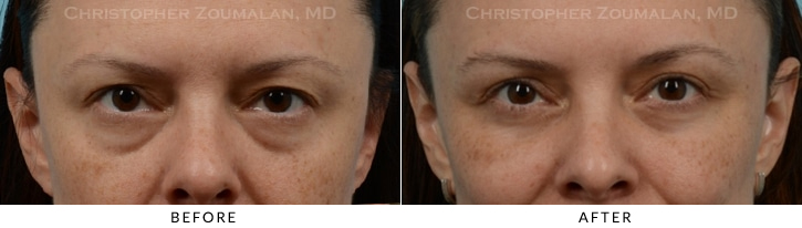 Quad Blepharoplasty Before & After Photo - Patient Seeing Straight - Patient 37B