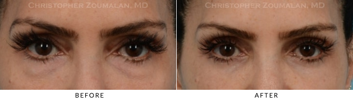 Quad Blepharoplasty Before & After Photo -  - Patient 38