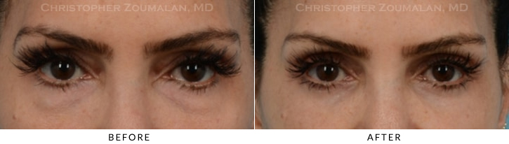 Quad Blepharoplasty Before & After Photo -  - Patient 38