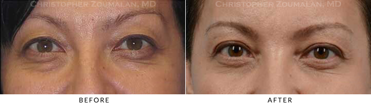 Quad Blepharoplasty Before & After Photo -  - Patient 39A
