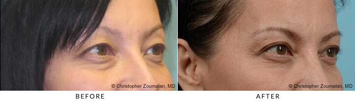 Quad Blepharoplasty Before & After Photo - Patient Seeing Straight - Patient 39B
