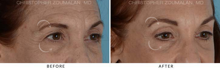 Quad Blepharoplasty Before & After Photo - Patient Seeing Side - Patient 12C