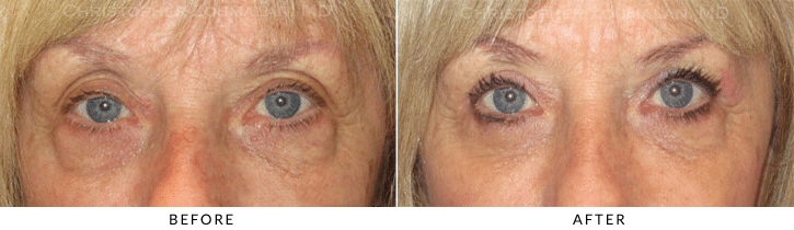 Quad Blepharoplasty Before & After Photo - Patient Seeing Straight - Patient 44A