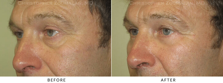 Quad Blepharoplasty Before & After Photo - Patient Seeing Side - Patient 45B