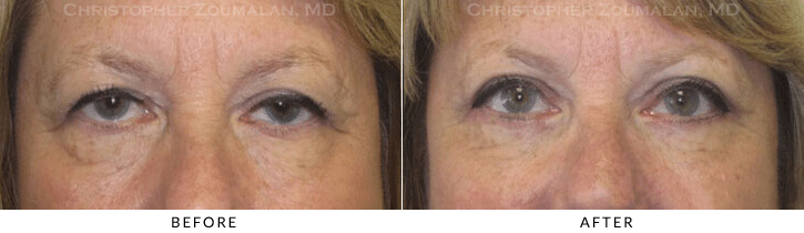 Quad Blepharoplasty Before & After Photo -  - Patient 46