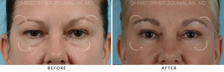 Quad Blepharoplasty Before & After Photo - Patient Seeing Straight - Patient 13A