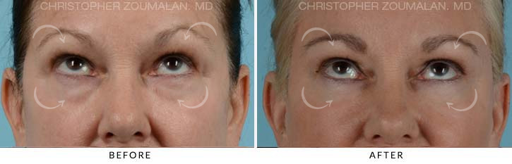 Quad Blepharoplasty Before & After Photo - Patient Seeing Up - Patient 13B