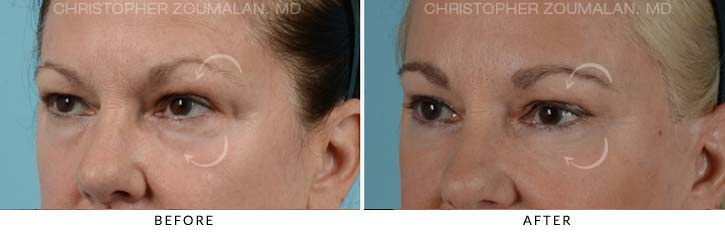 Quad Blepharoplasty Before & After Photo - Patient Seeing Side - Patient 13C