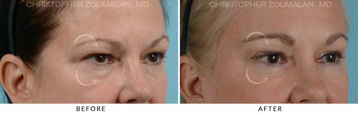 Quad Blepharoplasty Before & After Photo - Patient Seeing Side - Patient 13D