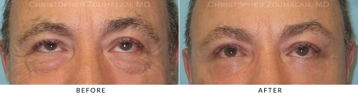 Quad Blepharoplasty Before & After Photo - Patient Seeing Up - Patient 51C