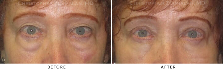 Quad Blepharoplasty Before & After Photo -  - Patient 52
